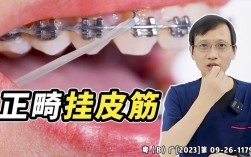 牙科正畸放橡皮筋视频该怎么操作？