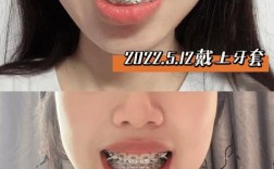 矫正牙齿半年变化图效果能有多惊艳？