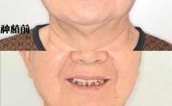 60多岁适合种牙吗