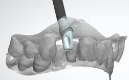 植牙个性化基台