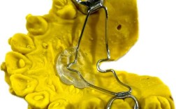 口腔正畸tpa的应用