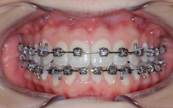 正畸期间托槽磨牙齿