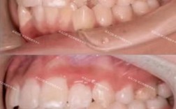 拥挤牙齿矫正失败案例频发，究竟哪些环节导致矫正失败？