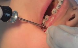 正畸二类牵引不打骨钉