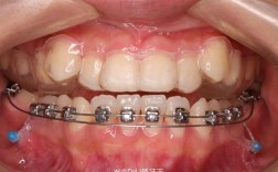 正畸牵引钩没带橡皮会有什么影响？