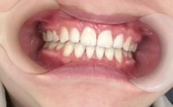 牙齿矫正后牙龈萎缩，矫正过程是诱因吗？