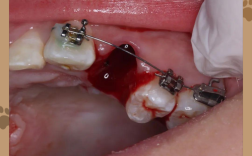 正畸有拔一颗牙的么