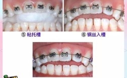 牙齿松动固定有哪些有效方法？