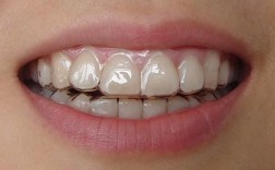 隐形矫正牙齿地包天