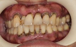 慢性牙周病种牙前必须先治疗吗？