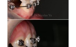 牙齿双颌前突矫正