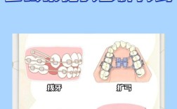 正畸牙矫正方法有几种？不同方法如何选择适合自己的？