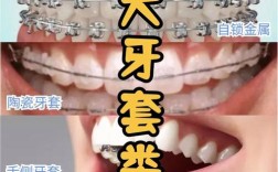 传统正畸有哪些