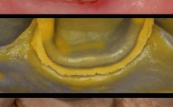 硅橡胶取桩核视频中，取桩核方法的具体操作步骤是怎样的？
