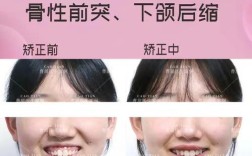 成人牙齿前突矫正