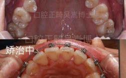 矫正牙齿中缝不齐，是什么原因导致的？