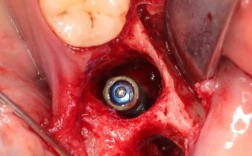 种植牙植骨肿痛