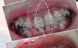 牙齿矫正导致中线不齐