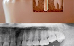 种植牙必须杀牙神经吗？哪些情况需要，哪些不用？