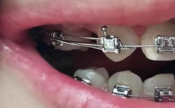 矫正牙齿反弹出现缝隙，是什么原因导致的？