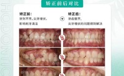 湛江牙齿矫正哪里好？求专业靠谱机构推荐和避坑经验分享！
