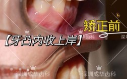 牙齿正畸过程深覆盖