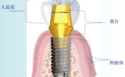 植牙 基台要钱吗