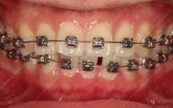 呼市矫正牙齿去哪儿做？靠谱机构推荐指南