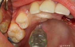 正畸闭合开窗术