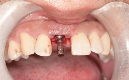 种牙术后口腔感觉有味道？原因分析与护理建议