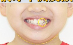 矫正牙齿不拔牙，反弹原因是什么？