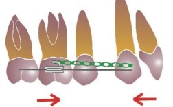 正畸方案间隙分析