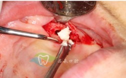 口腔骨性正畸手术是什么？效果和风险如何？