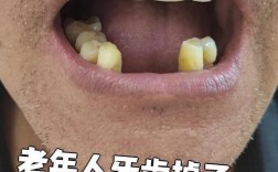 牙掉了能种牙吗