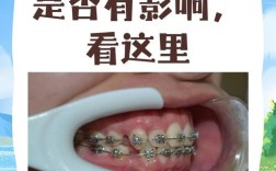 牙齿矫正一定要拔牙吗？哪些情况需要这样做？