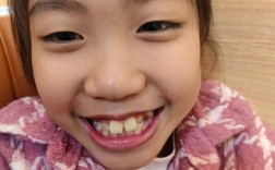 正畸帽子挂钩变直了，是什么原因导致的？