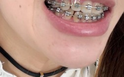 南京市口腔医院正畸效果怎么样？真实案例与效果评价如何？