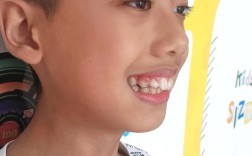 5月15日正畸，当天有哪些注意事项？