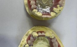 活动义齿软衬方法如何选择与应用？