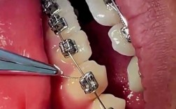 金属牙冠固定方法有哪些？如何确保牢固持久？