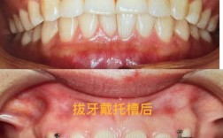 矫正牙齿有拔大牙的吗