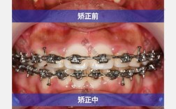 正畸后面前面高比会有哪些变化？