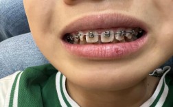 浙江矫正牙齿哪里好？求推荐靠谱机构或医生