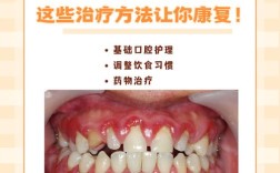 口腔溃疡能种牙吗？