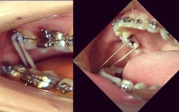 正畸支抗钉各种挂具体指哪些应用技巧？