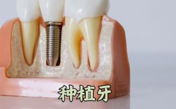 北京种牙选哪家医院医生技术好口碑佳价格合理？