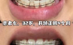 门牙开合想做正畸，矫正效果怎么样？