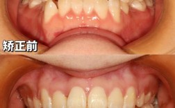 矫正牙齿和美白牙齿，先做哪个更合适？