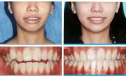 下颌曲线反了，正畸矫正有哪些注意事项？