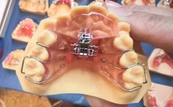 正畸中整体移动